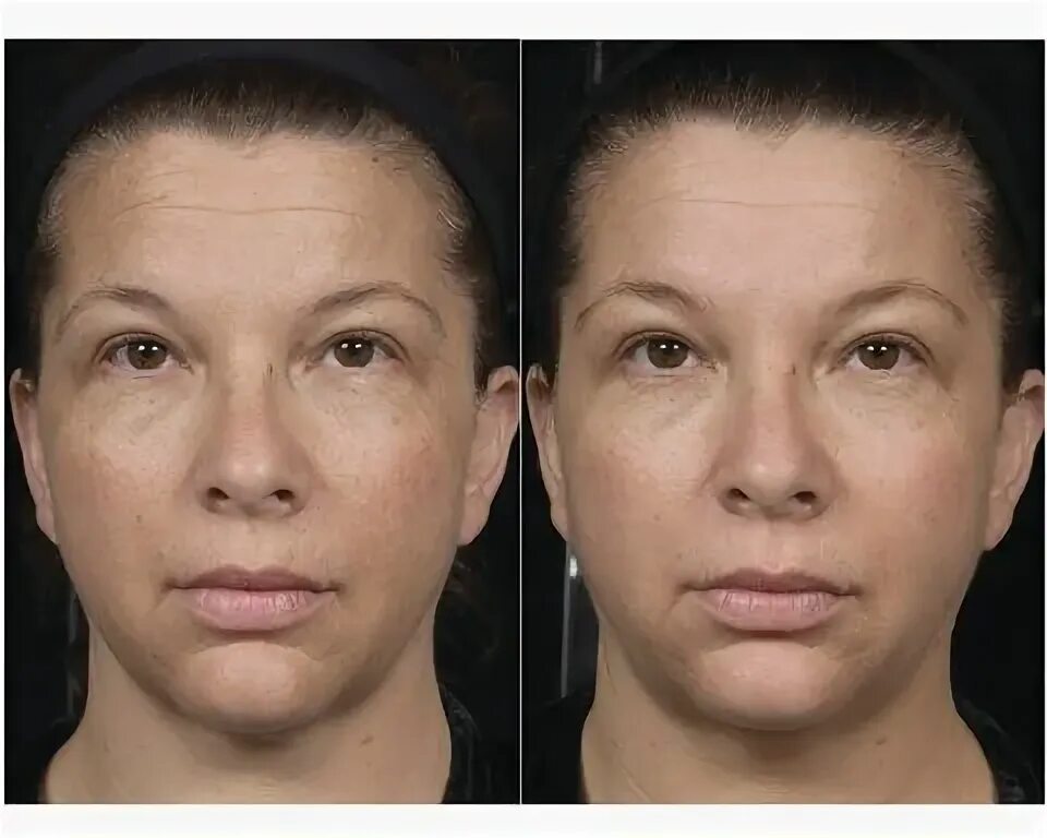 Реви фото до и после 1 week post 6 treatments of Clear+Brilliant combined with SkinCeuticals CE Ferul