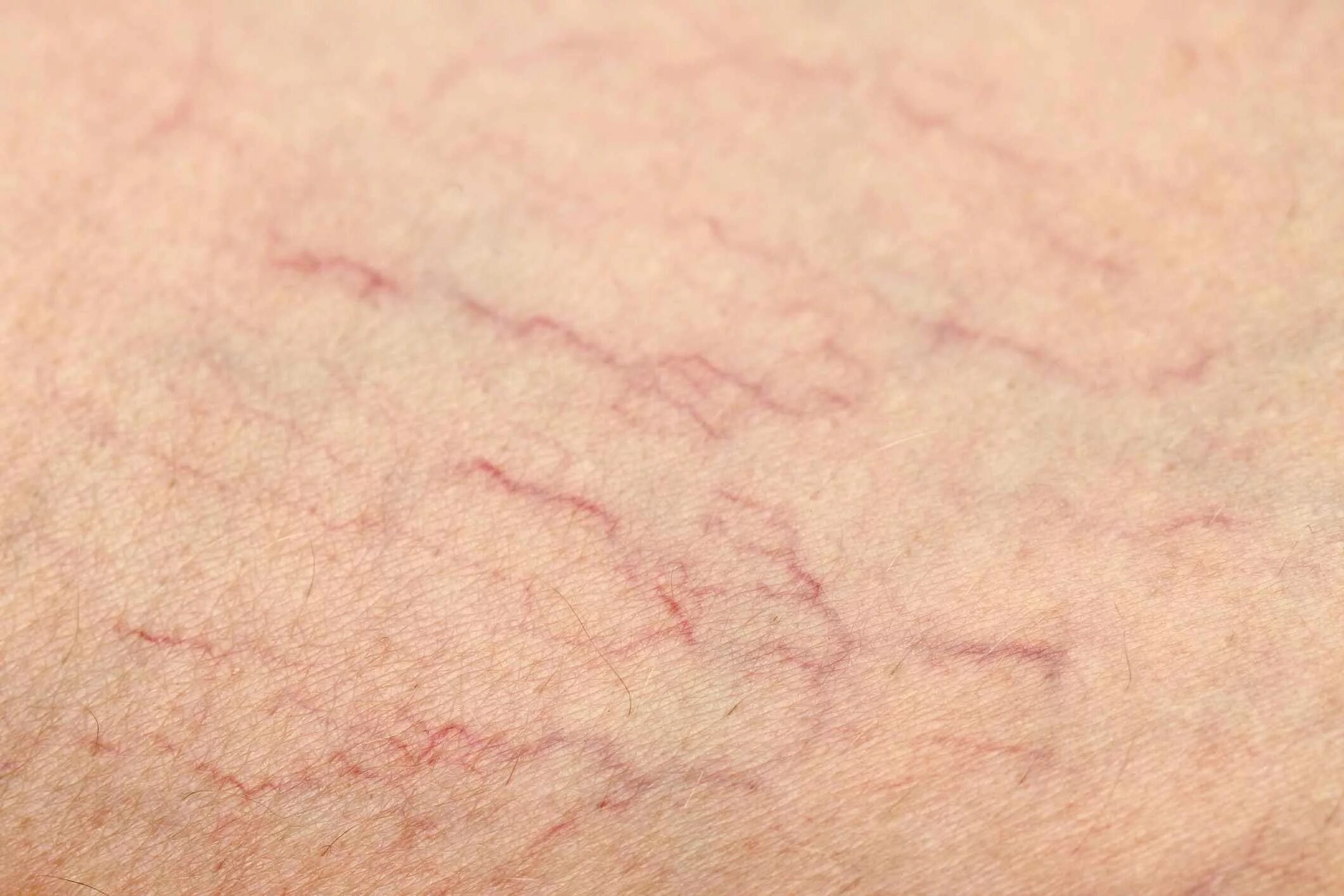 Ревматоидная сыпь фото Causes and Prevention of Varicose and Spider Veins