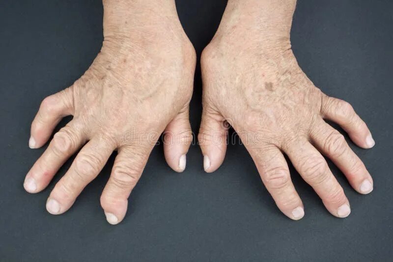 Ревматоидные руки фото Rheumatoid Arthritis hands stock image. Image of patient - 41402001