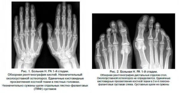 Ревматоидный артрит фото кистей начальная стадия Рентгенологические стадии ревматоидного артрита: снимки и их расшифровка