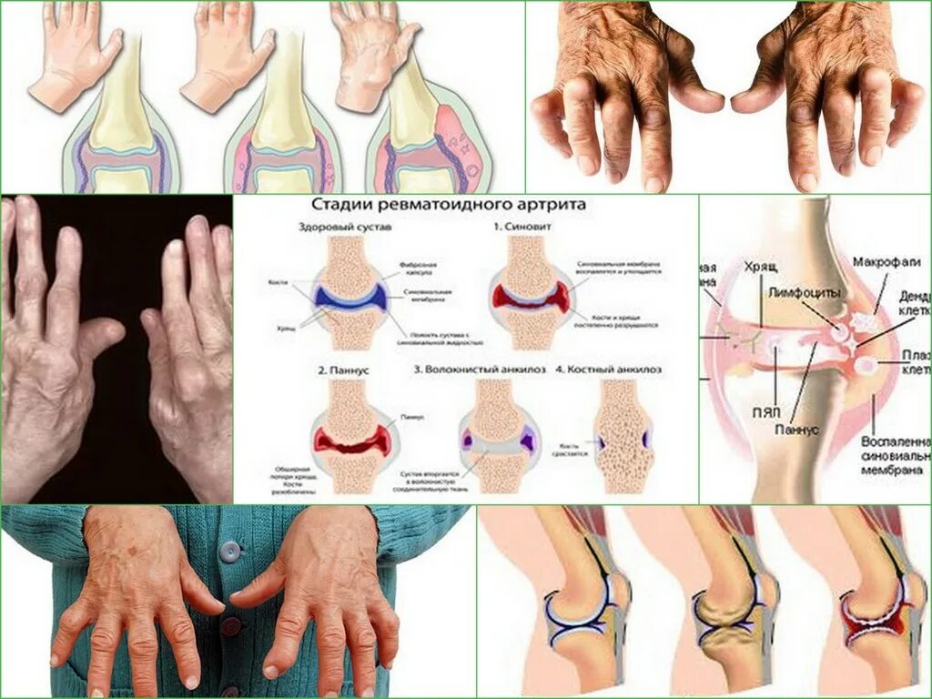 Ревматоидный артрит симптомы фото Ревматоидный артрит - симптомы, диагностика и лечение