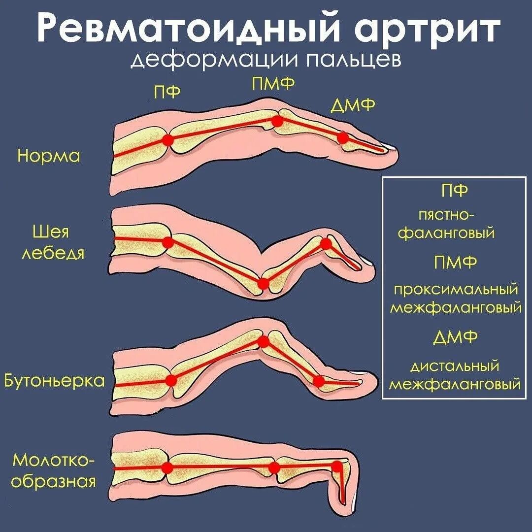 Ревматоидный артрит симптомы фото #3096 post - Я СТУДЕНТ МЕДИК (@student_medik)