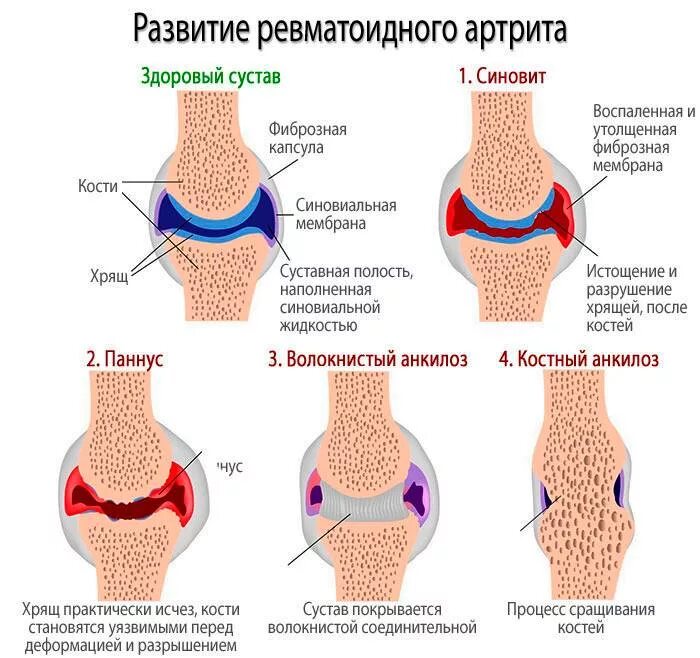 Ревматоидный артрит симптомы у женщин фото Первые симптомы ревматоидного артрита