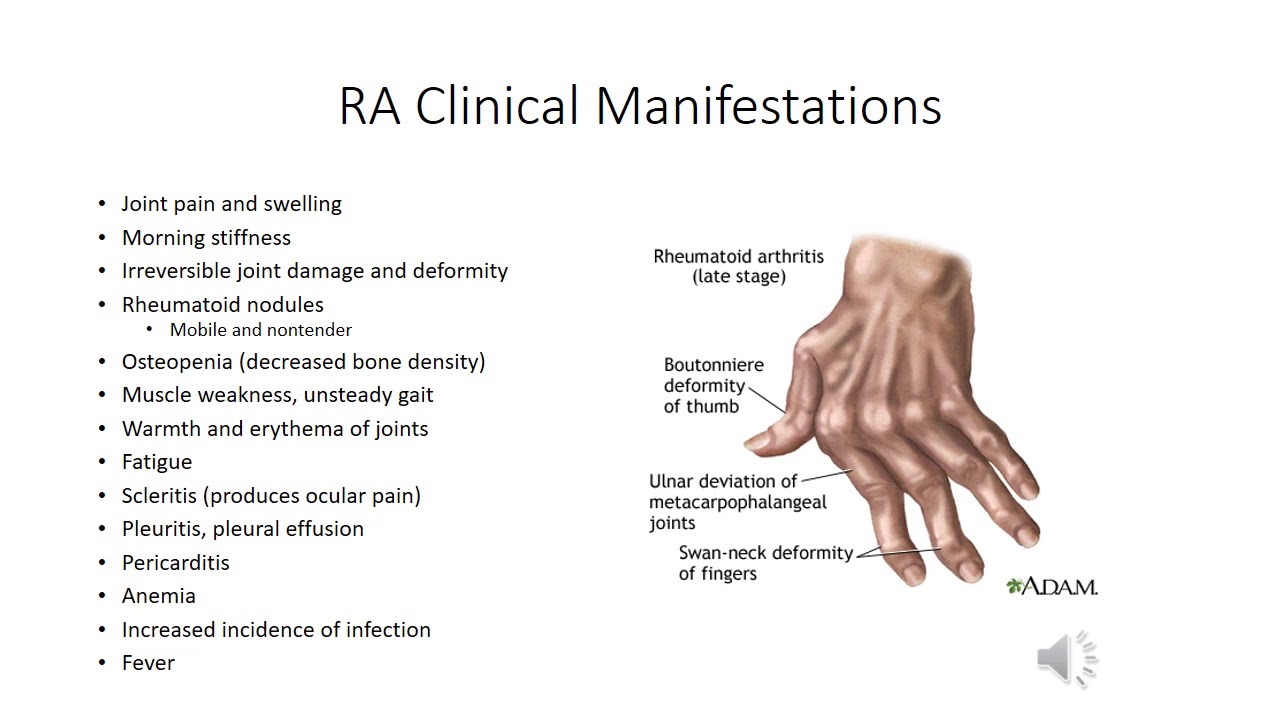 Ревматоидный артрит симптомы у женщин фото 3-3 Connective Tissue Disorders Combined - YouTube