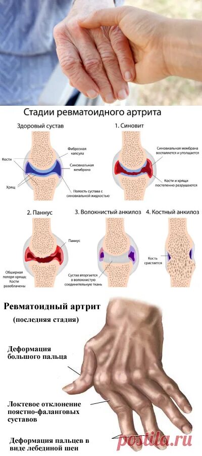 Ревматоидный артрит симптомы у женщин фото Ревматоидный артрит - следствие нашего образа жизни! Сияние Жизни ЗДОРОВЬЕ энцик