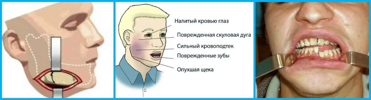 Резекция верхней челюсти фото Болят зубы верхняя и нижняя челюсть