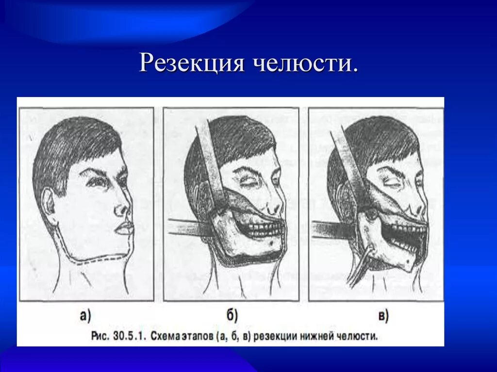 Резекция верхней челюсти фото Операция резекции верхней челюсти: найдено 84 изображений