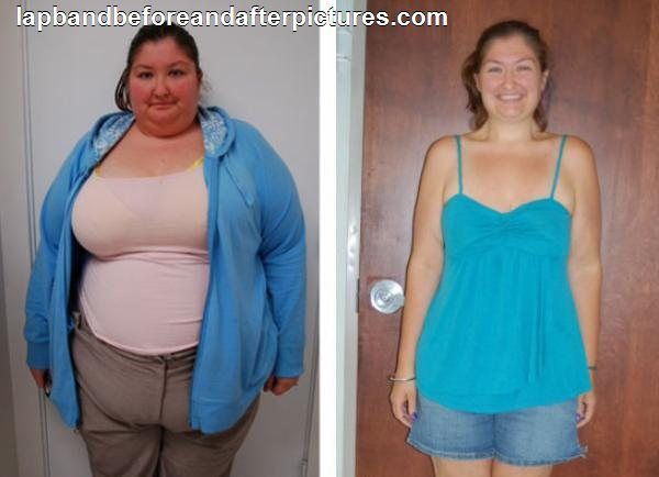 Резекция желудка фото до и после Pin on Bariatric Surgery and Amazing Weightloss