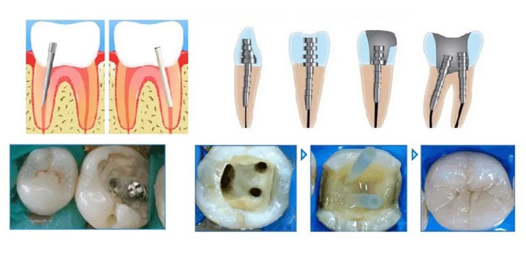 Резекция зуба фото Штифт в зубе - цена, виды, установка НоваДент