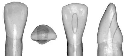 Резец зуб верхний фото Анатомия корневых каналов резца нижней челюсти и советы по препарированию полост
