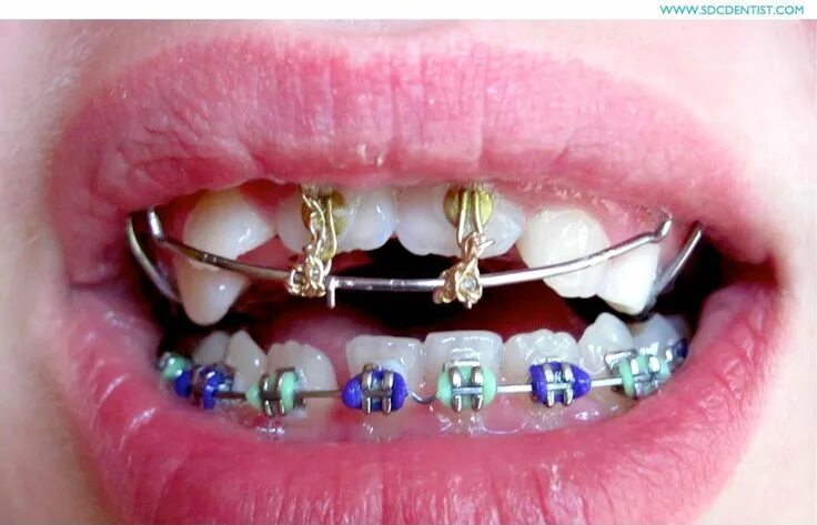 Резинки на зубах фото จ ด ฟ น ข น ต อ น ก อ น จ ด ฟ น (Braces 1-2-3) Power chain braces, Braces colors