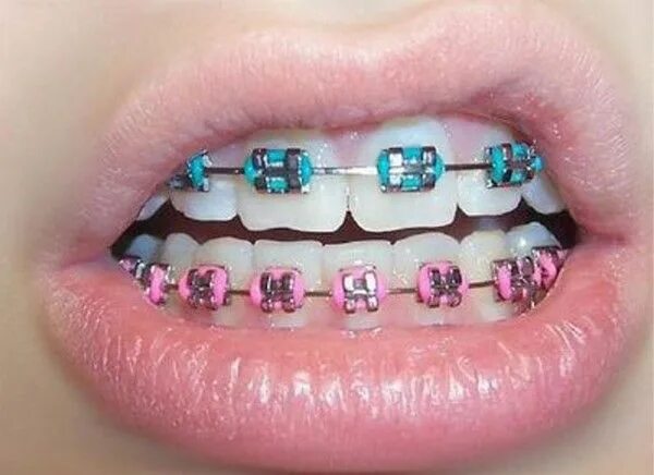 Резинки на зубах фото cool teeth braces pink and blue color #colorful #teeth #braces #ideas Tandställn