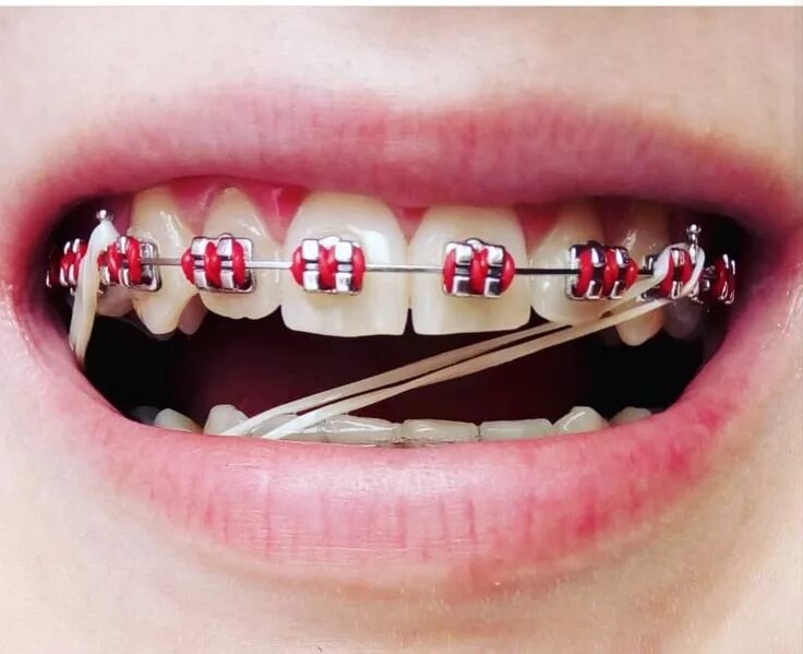 Резинки на зубах фото Pin de Sheri Nicolls en Braces Brackets dentales, Ligas para brackets, Dientes c