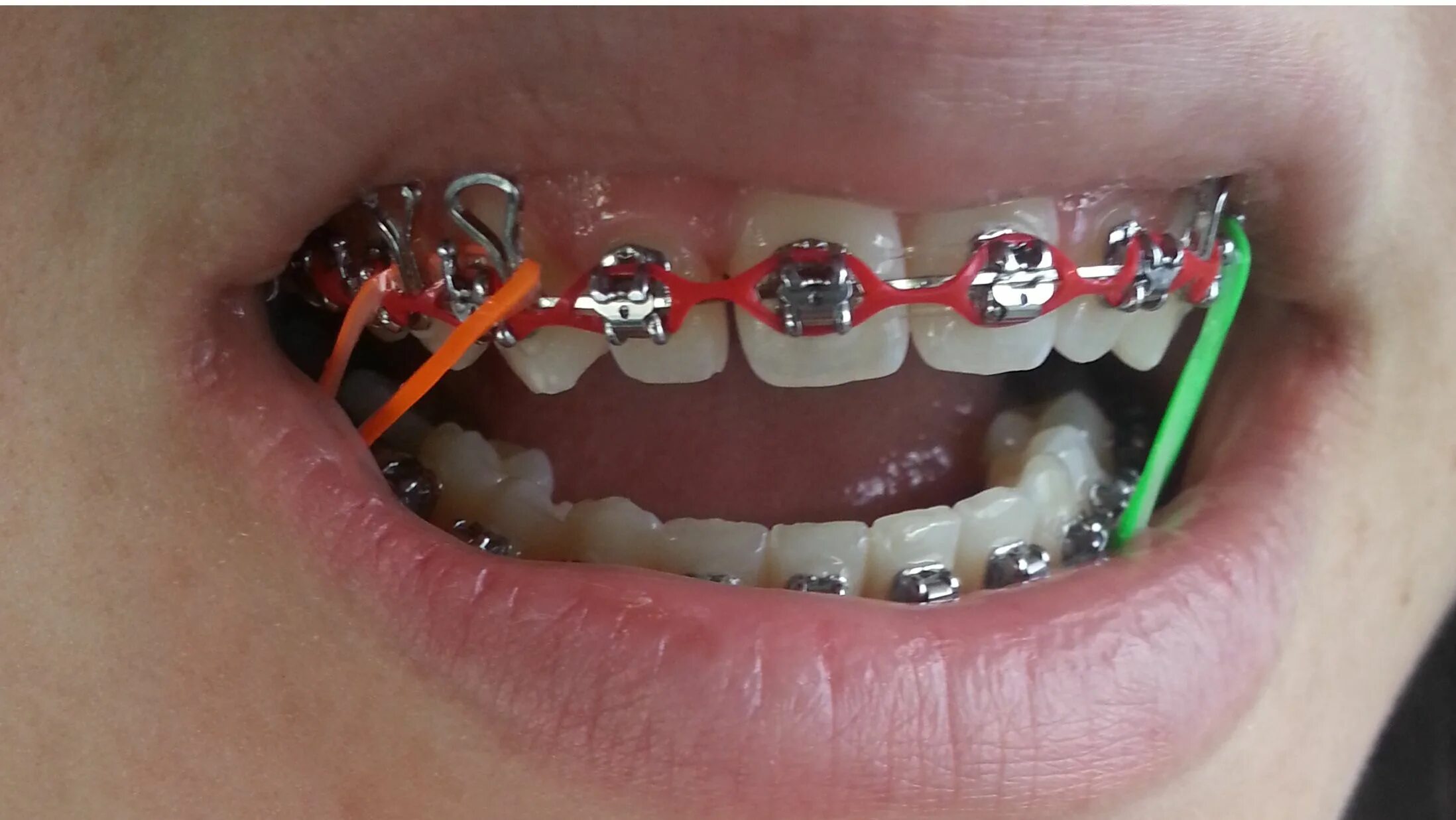 Резинки на зубах фото Pin en Power chain Ortodoncia, Brackets, Dientes