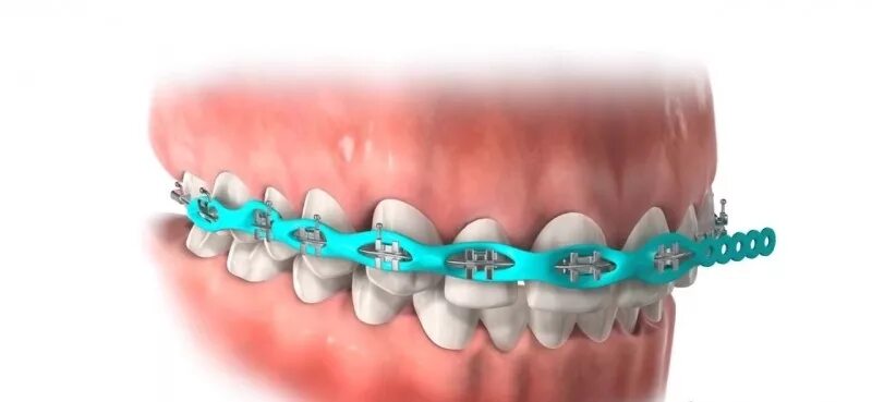 Резинки на зубах фото Как устроены брекеты. Лигатура и другие вспомогательные материалы статья пациент