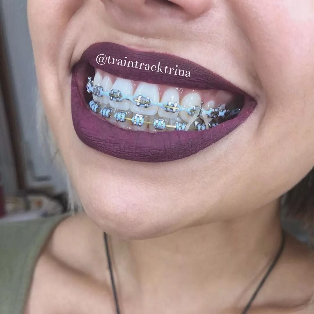 Резинки на зубах фото Image may contain: one or more people and closeup Dental braces, Teeth braces, B