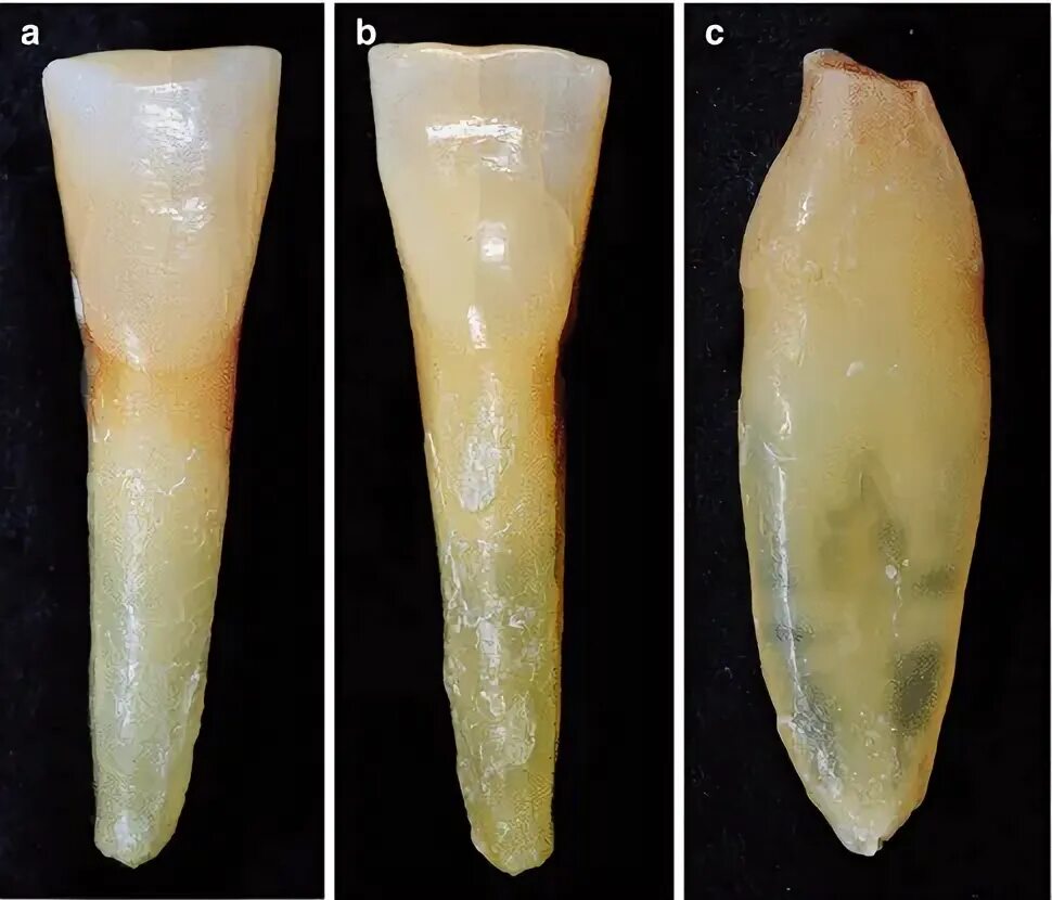 Резцы передние на верхней челюсти высокие фото Endodontic Morphology and Anatomy of Human Teeth Pocket Dentistry