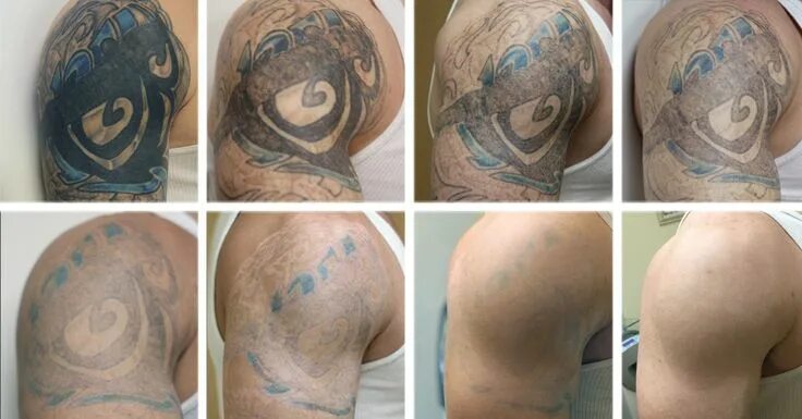 Результат после удаления тату лазером фото Sugar Land Laser Tattoo Removal Prices In Houston, TX Tattoo removal, Laser tatt